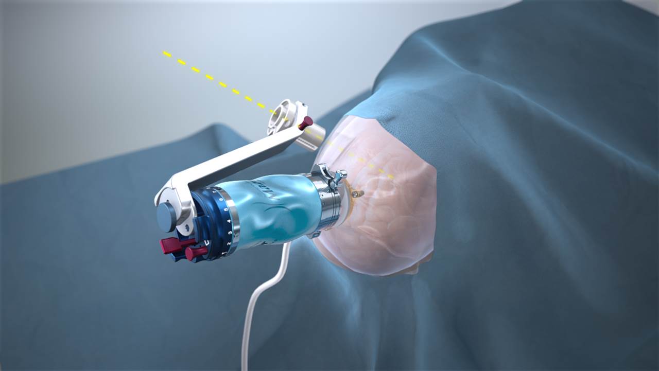 A Study On Robotic Brain Surgery